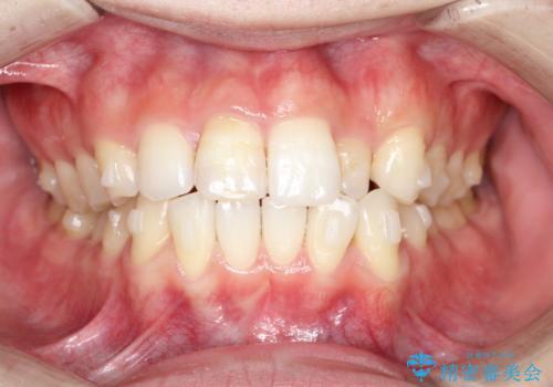 インビザラインとセラミック治療で整った歯並びへの治療中