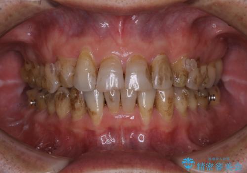 マウスピース矯正(インビザライン)中にコーヒの頑固な着色落としをPMTCでの症例 治療前