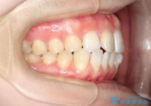 インビザラインとセラミック治療で整った歯並びへの治療中
