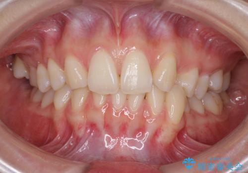 上顎前歯が2本欠損　インビザラインによる叢生の解消の症例 治療前