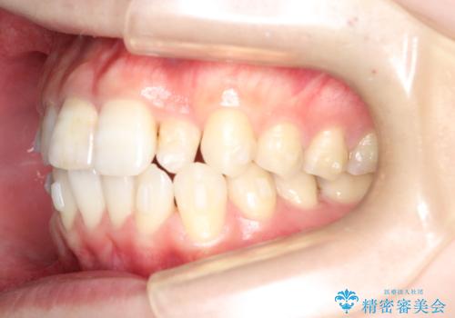 インビザラインとセラミック治療で整った歯並びへの治療中