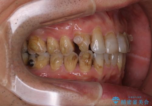 マウスピース矯正(インビザライン)中にコーヒの頑固な着色落としをPMTCでの治療前