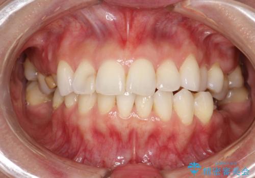 マスクにより感じる口臭をPMTCで対策の治療前