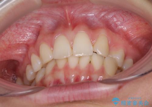 上顎前歯が2本欠損 インビザラインによる叢生の解消の治療前