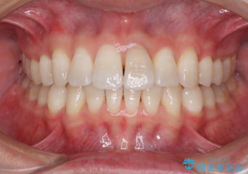 前歯のデコボコを治したい インビザラインによる矯正治療の治療中