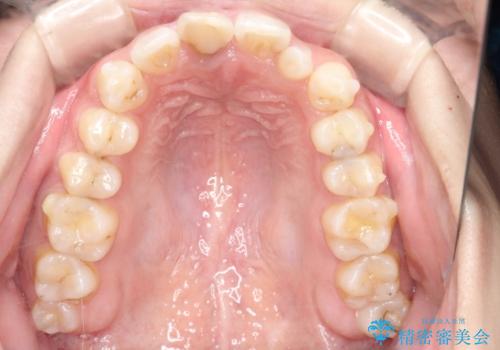 インビザラインとセラミック治療で整った歯並びへの治療中