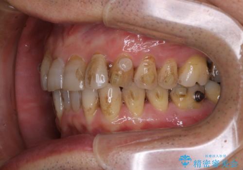 マウスピース矯正(インビザライン)中にコーヒの頑固な着色落としをPMTCでの治療前