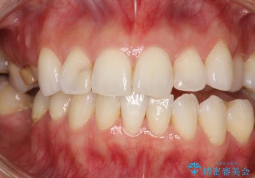 マスクにより感じる口臭をPMTCで対策の治療前