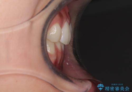 上顎前歯が2本欠損 インビザラインによる叢生の解消の治療前