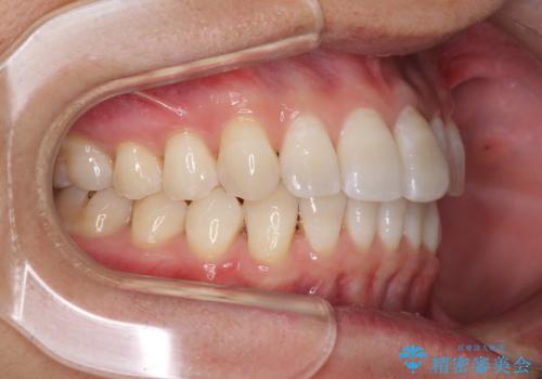 前歯のデコボコを治したい インビザラインによる矯正治療の治療中