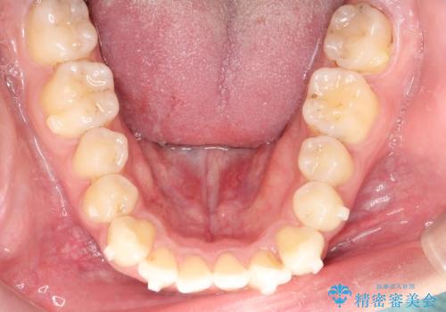 インビザラインとセラミック治療で整った歯並びへの治療中