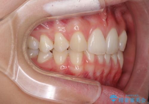 上顎前歯が2本欠損 インビザラインによる叢生の解消の治療前