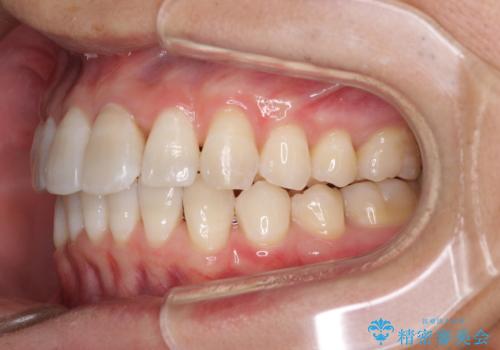 前歯のデコボコを治したい インビザラインによる矯正治療の治療中