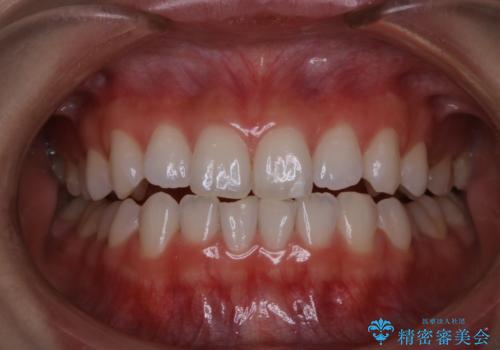 半年ぶりのホワイトニングの症例 治療前