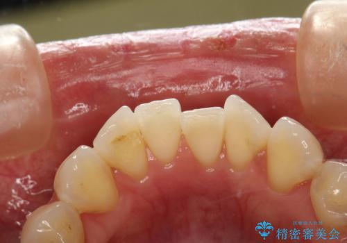 マスクにより感じる口臭をPMTCで対策の治療前