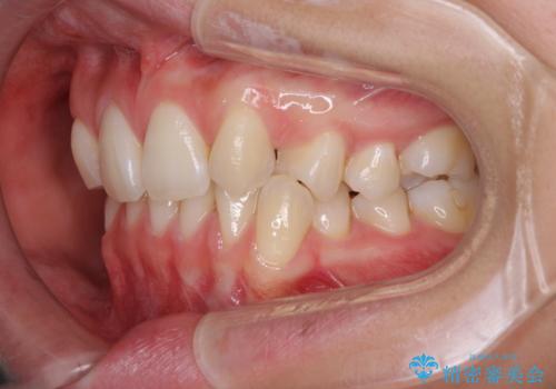 上顎前歯が2本欠損 インビザラインによる叢生の解消の治療前