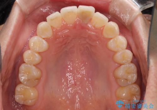 前歯のデコボコを治したい インビザラインによる矯正治療の治療中