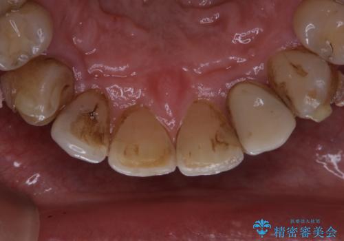 マウスピース矯正(インビザライン)中にコーヒの頑固な着色落としをPMTCでの治療前