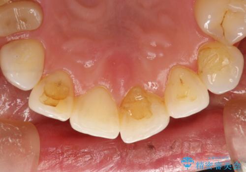 マスクにより感じる口臭をPMTCで対策の治療前