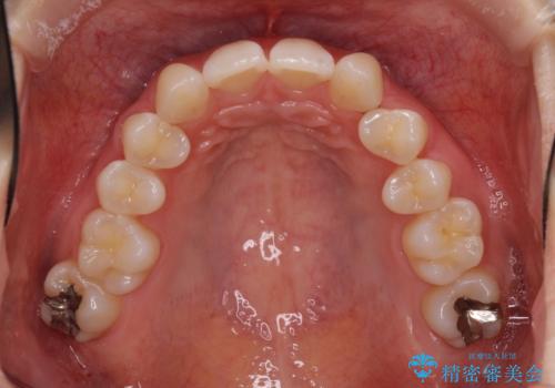 上顎前歯が2本欠損 インビザラインによる叢生の解消の治療前