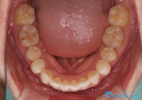 前歯のデコボコを治したい インビザラインによる矯正治療の治療中