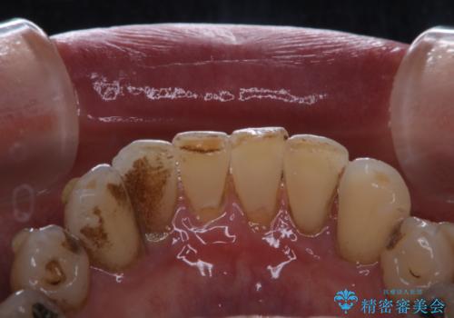 マウスピース矯正(インビザライン)中にコーヒの頑固な着色落としをPMTCでの治療前