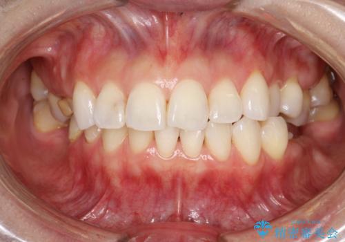 マスクにより感じる口臭をPMTCで対策の治療後