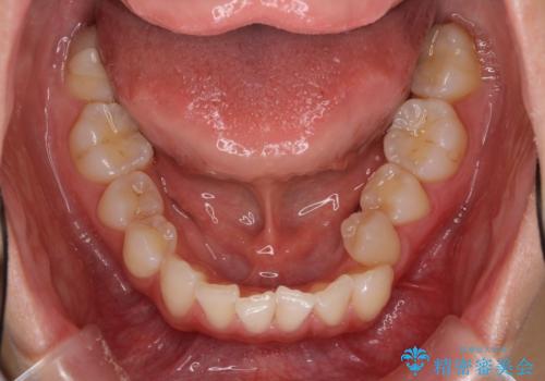 上顎前歯が2本欠損 インビザラインによる叢生の解消の治療前