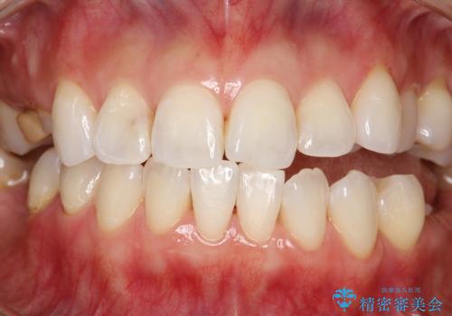 マスクにより感じる口臭をPMTCで対策の治療後