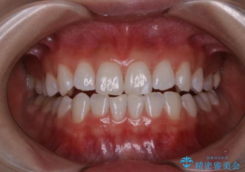 半年ぶりのホワイトニング