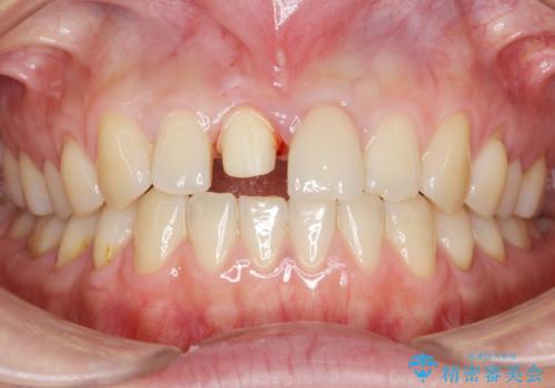 歯が折れた セラミックで綺麗に 30代女性の治療中