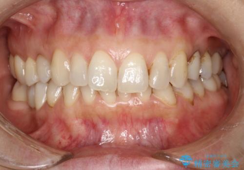 PMTCで歯と歯の間の細かいステインの除去の治療前