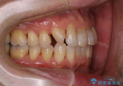 マウスピース矯正(インビザライン)中にコーヒの頑固な着色落としをPMTCでの治療後