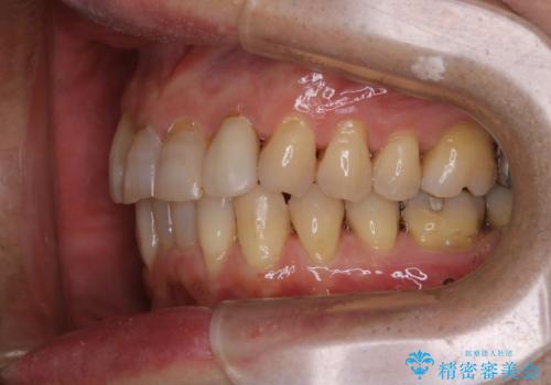 マウスピース矯正(インビザライン)中にコーヒの頑固な着色落としをPMTCでの治療後