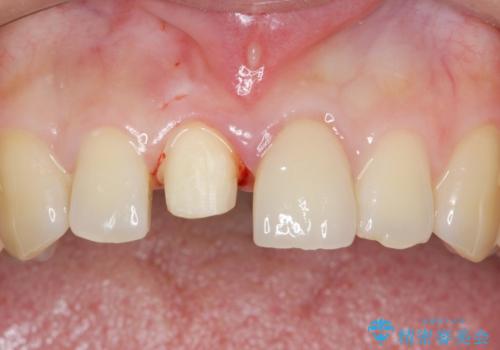 歯が折れた セラミックで綺麗に 30代女性の治療中