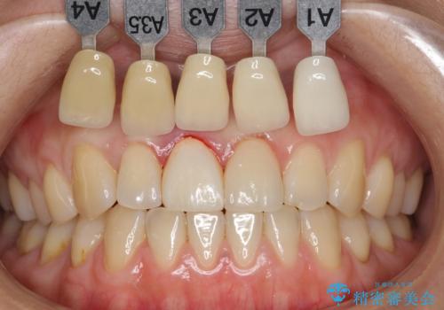 歯が折れた セラミックで綺麗に 30代女性の治療中