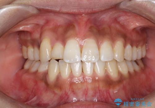 インビザラインと補助装置の併用による八重歯の抜歯矯正の症例 治療後