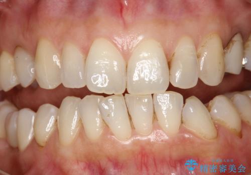 PMTCで歯と歯の間の細かいステインの除去の治療前