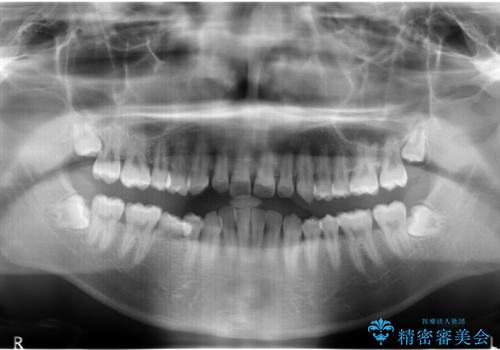 20代男性　奥歯のインプラント　自分の骨を移植の治療前