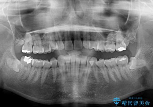 上顎前歯が2本欠損 インビザラインによる叢生の解消の治療前
