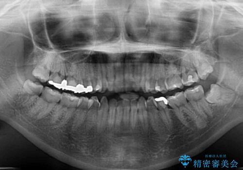 前歯のデコボコを改善 目立たないワイヤー矯正の治療前