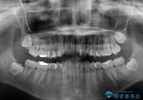 短期間で終了 デコボコをワイヤー矯正で解消の治療前