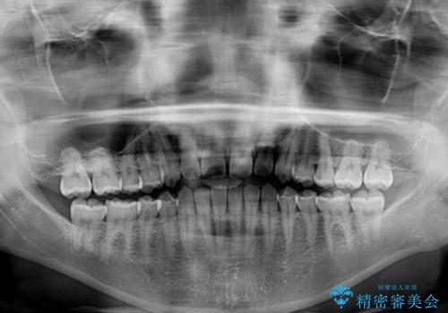 気になる隙間の再矯正 前歯をインビザライン・ライトで改善の治療前