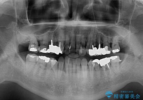 歯列不正と歯周病 総合歯科治療による全顎治療の治療前