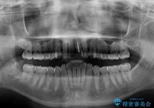 前歯のデコボコを治したい インビザラインによる矯正治療の治療前