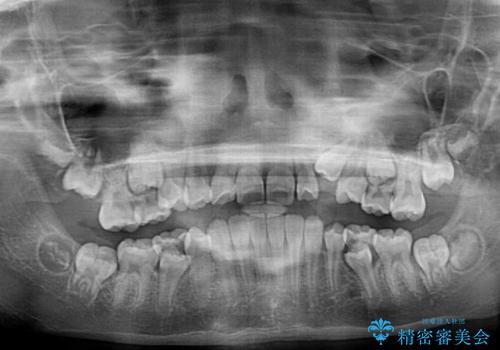 埋もれた犬歯を引っ張り出す　小学生のⅠ期治療の治療前