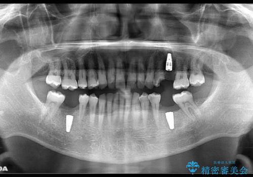 短期間で集中的に全顎治療の治療中