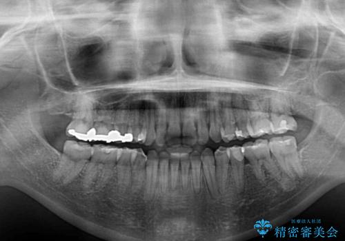前歯のデコボコを改善 目立たないワイヤー矯正の治療後