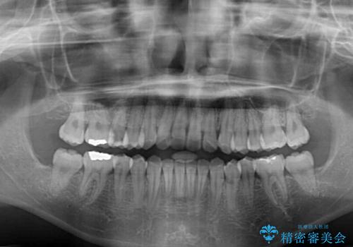 短期間で終了 デコボコをワイヤー矯正で解消の治療後