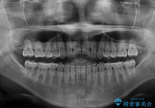 気になる隙間の再矯正 前歯をインビザライン・ライトで改善の治療後